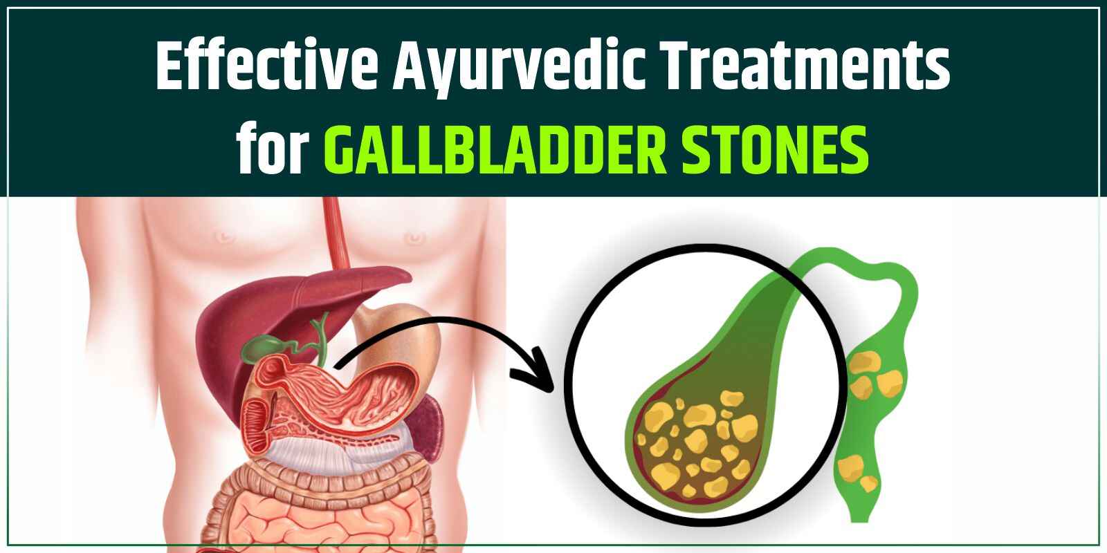 Ayurvedic Treatments for Gallbladder Stones